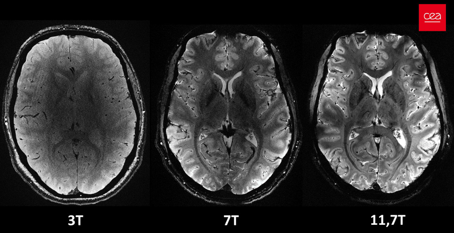 World’s most powerful MRI  scanner images the living brain with unrivaled clarity